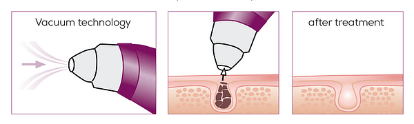 работа очистителя пор.png работа очистителя пор.png