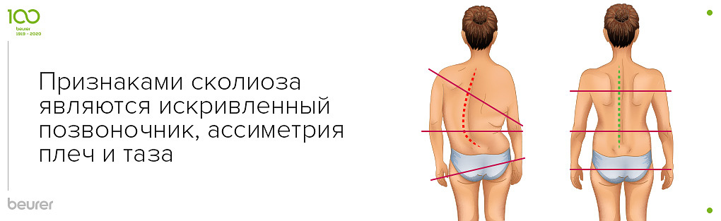Признаками сколиоза являются искривленный позвоночник, ассиметрия плеч и таза