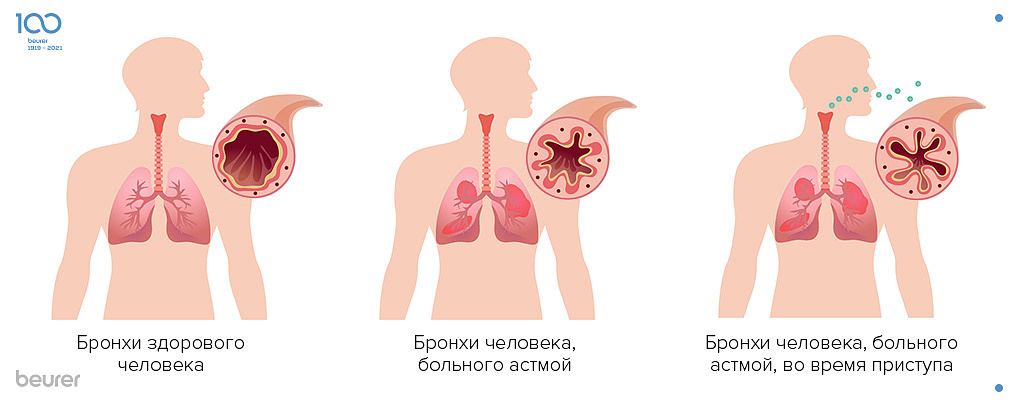 Легкие при астме Легкие при астме