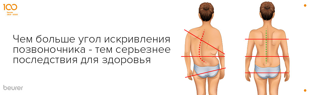 чем больше угол искривления позвоночника тем серьезнее последствия для здоровья.jpg