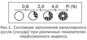Состояние заполнения капиллярного русла (сосуда) при различных показателях перфузионного индекса..jpg