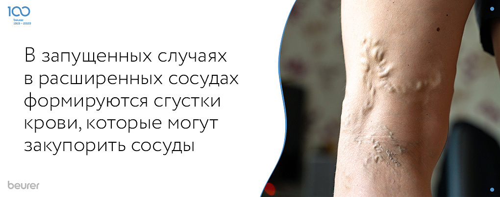 В запущенных случаях в расширенных сосудах формируются сгустки крови, которые могут закупорить сосуды.jpg В запущенных случаях в расширенных сосудах формируются сгустки крови, которые могут закупорить сосуды.jpg