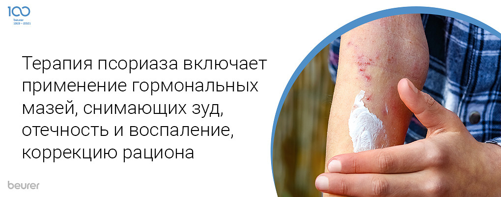 Терапия псориаза включает применение гормональных мазей, снимающих зуд, отечность и воспаление, коррекцию рациона