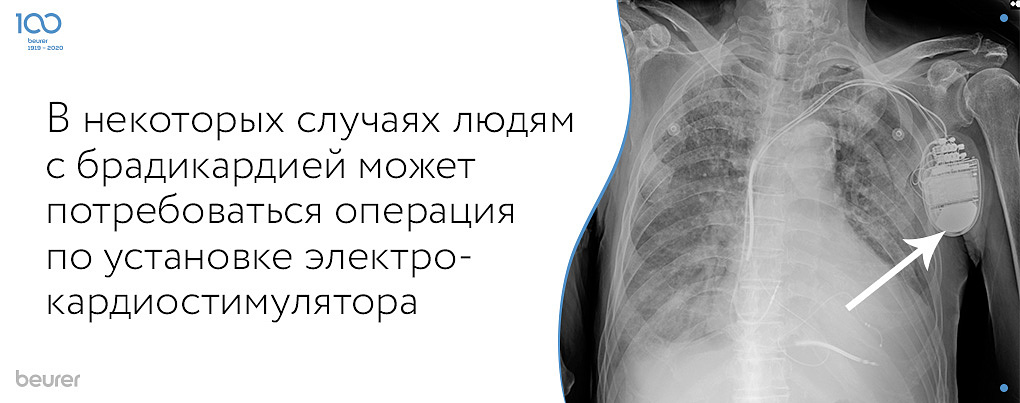 В некоторых случаях людям с брадикаржией может потребоваться операция по установке электрокардиостимулятора.jpg
