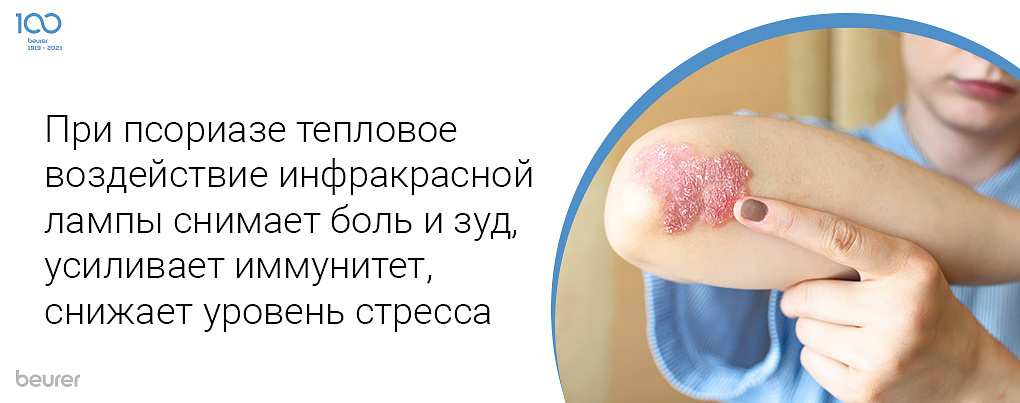 При псориазе тепловое воздействие инфракрасной лампы снимает боль и зуд, усиливает иммунитет, снижает уровень стресса